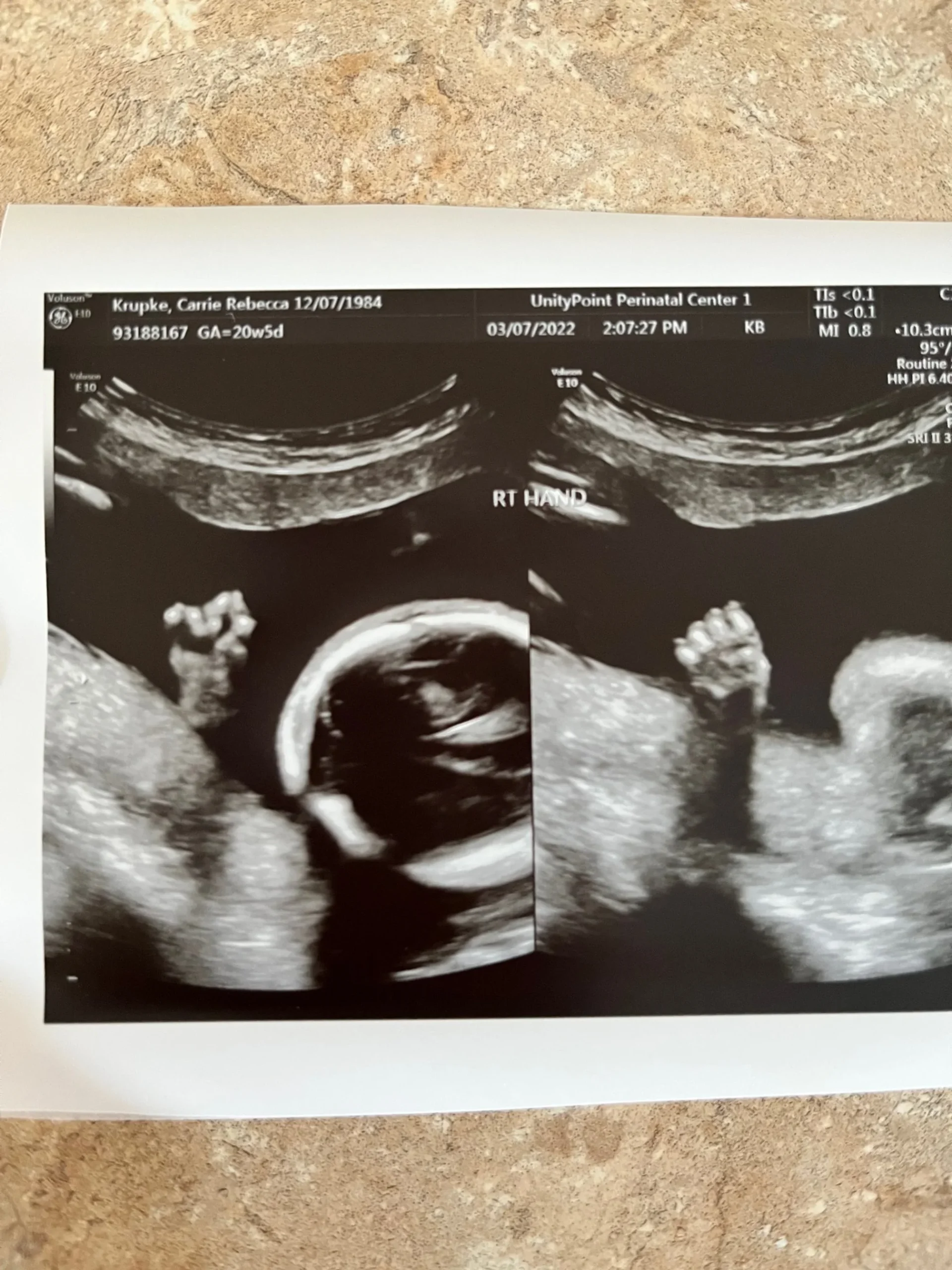  a punching right fist that clocked the ultrasound wand :) She’s a fighter! 